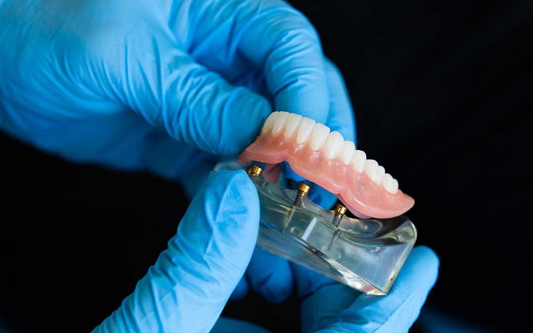 prótesis dentales tipos