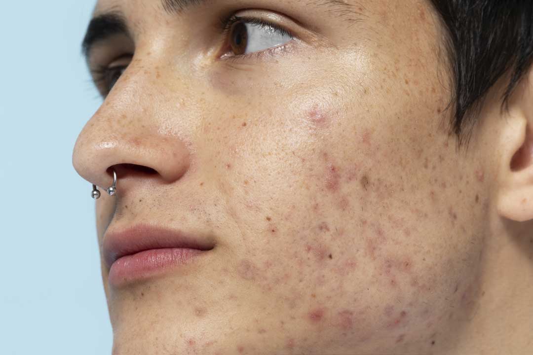 acne malalties de la pell 
